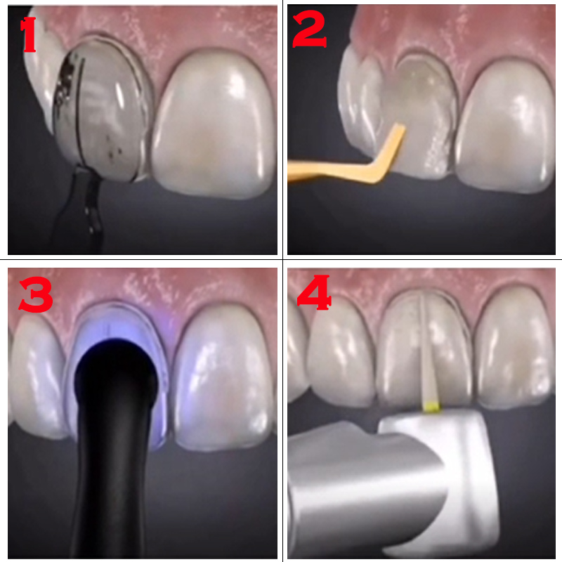 قالب قشرة أسنان قابل للتعقيم ب - مراجعة Teeth Whitening Quick وسعره